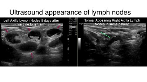 Swollen Lymph Nodes Armpit Ultrasound