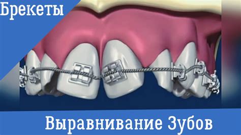 Ортодонтия. Брекеты. Выравнивание зубов - YouTube