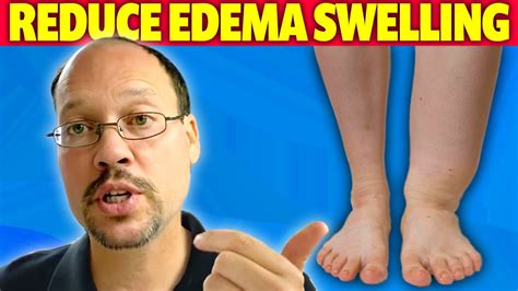 Swelling Edema In Ankles And Kidney Disease 3 Tips For Improving It