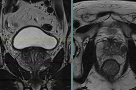 Das Multiparametrische Prostata Mrt Gemeinschaftspraxis Radiologie