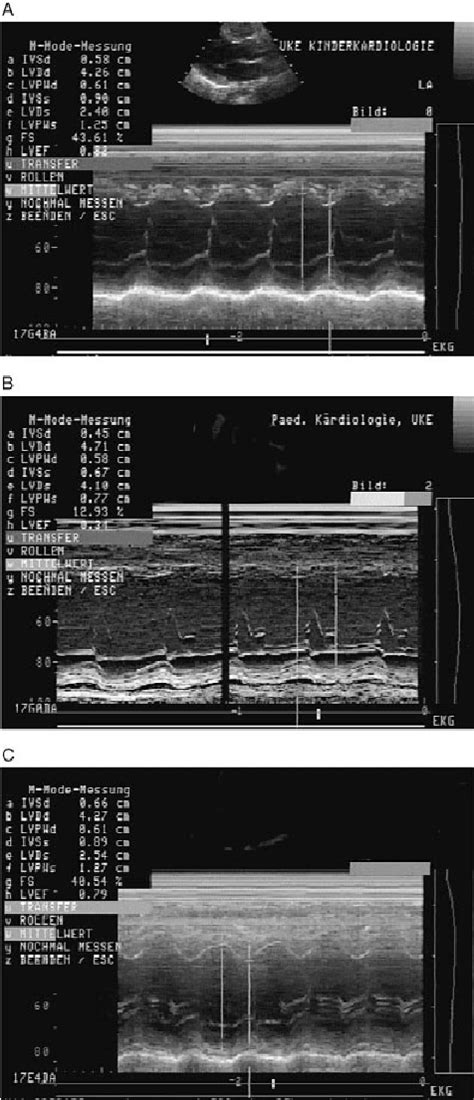 A Preoperative Echocardiography Parasternal Long Axis View M Mode