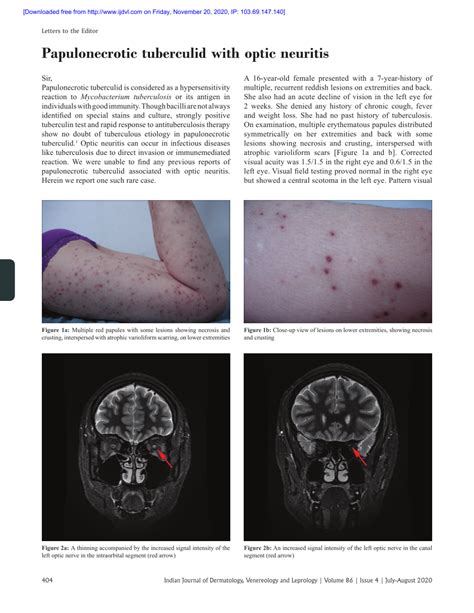 Pdf Papulonecrotic Tuberculid With Optic Neuritis