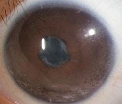 Iritis - American Association for Pediatric Ophthalmology and Strabismus