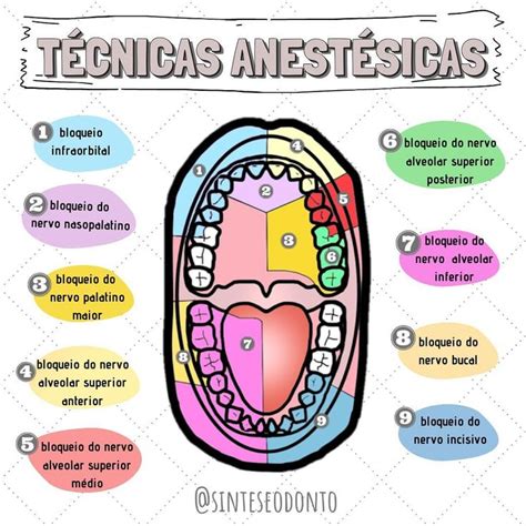 Anestesia Dental Bloqueo Del Nervio Dentario Inferior