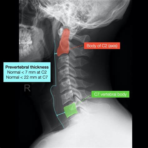 Prevertebral Thickness Medical Radiography Radiology Imaging