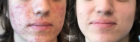 Treatment For Acne Accutane Peels And Lasers