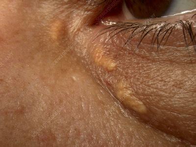 Xanthelasma Stock Image C006 3607 Science Photo Library