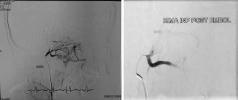 The Angiography Of Right Internal Maxillary Artery Before Left And Download Scientific