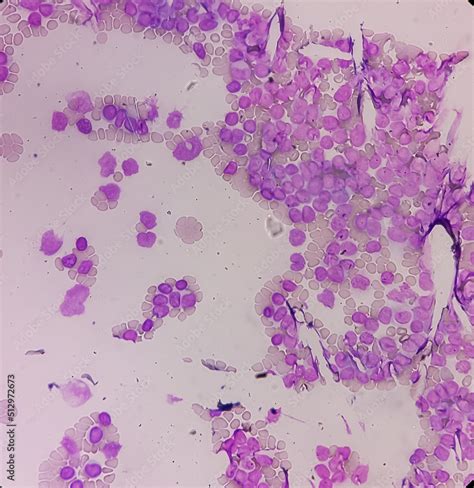 Acute Leukemia Peripheral Blood Smear Show Most Of Cell Are Blast Cell