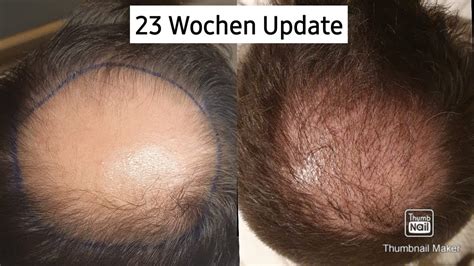 Haartransplantation Mit Elithair Verlauf 23 Wochen Update Es Wird