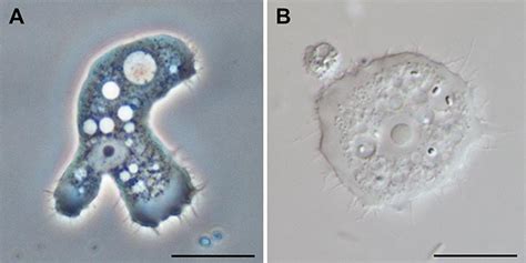 Acanthamoeba Keratitis Eyegotcha