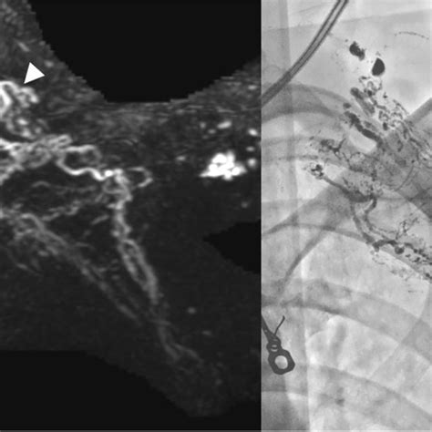 Thoracic Duct Td Embolization Patient With History Of Lung Carcinoma