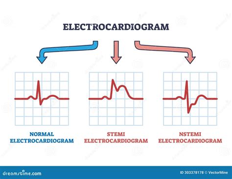 Electrocardiogram Stemi And Nstemi Abnormal Heart Rate Outline Diagram