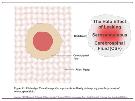 How To Check For A Csf Leak Internaljapan9