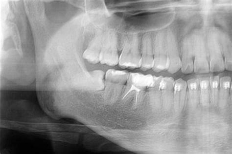 Extracción tercer molar inferior incluido o retenido