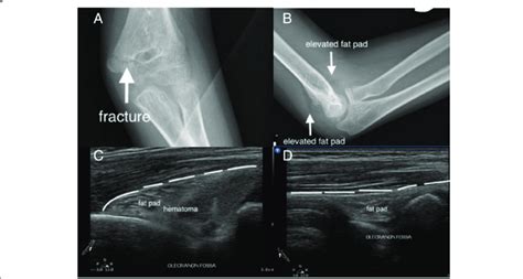 Sonographic Fat Pad Sign A Teenage Boy Injured His Elbow After A Fall