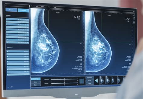 Breast Imaging Market Size Projection Shows Promising Growth Rate From 2028