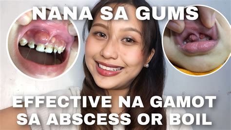 Effective Na Gamot Sa Abscess Boil Nana Sa Gums Youtube