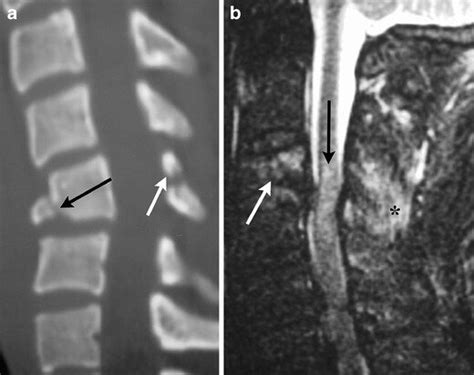 2 Flexion Teardrop Fracture A Sagittal Mdct Image Demonstrates Download Scientific Diagram