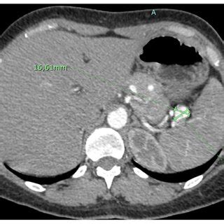 Small asymptomatic splenic artery aneurysm. | Download Scientific Diagram