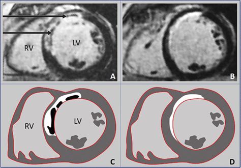 Cardiac Mri To Visualize Myocardial Damage After St Segment Elevation