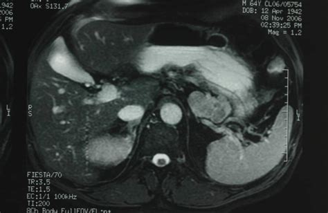 MRI Of The Cystic Teratoma Of The Pancreatic Tail Enhanced Magnetic