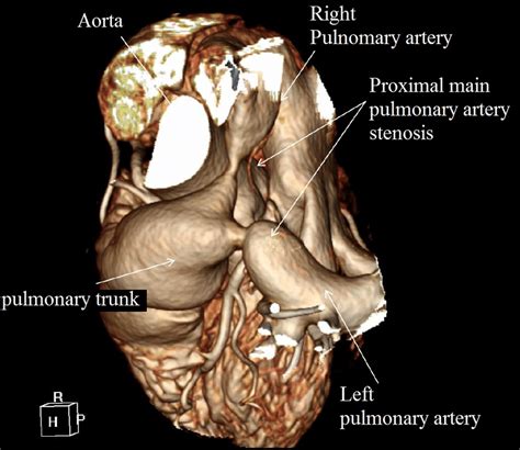 Left Pulmonary Artery