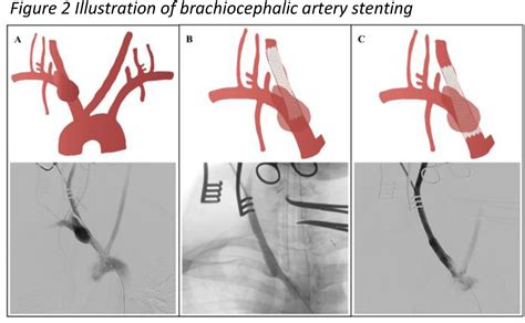 Hybrid Repair Of An Innominate Artery Pseudoaneurysm After Blunt Traumatic Injury In A Bovine