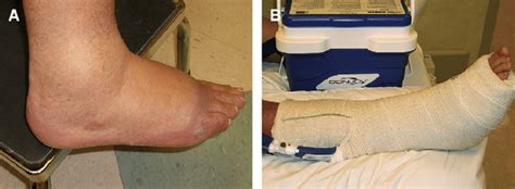 Closed Calcaneal Fracture With Substantial Swelling And Failure Of The