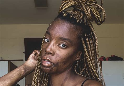 Woman Shares Pictures Embracing Her Scars And Goes Viral Youuuu Are A