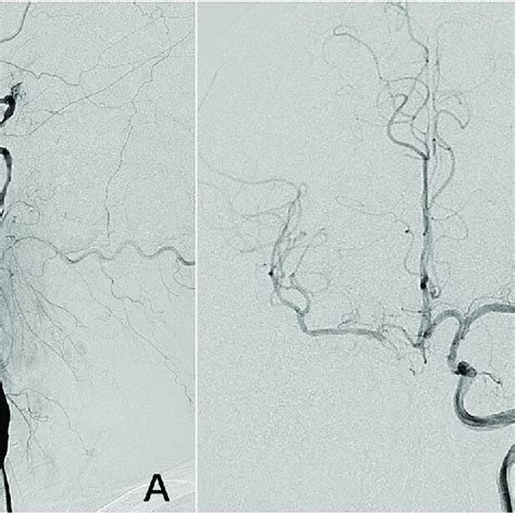 Angiography Of The Right Common Carotid Artery Showed Atrophy Of The