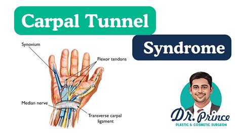 Carpal Tunnel Syndrome - topplasticsurgery