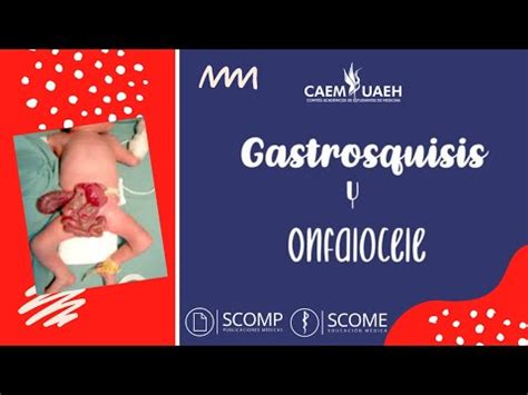 Gastrosquisis Y Onfalocele YouTube