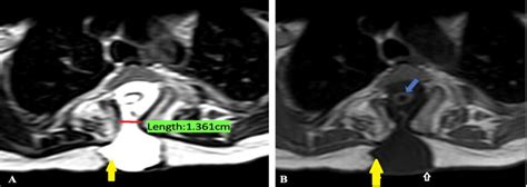 Axial Mri Images Figure 1a T2 Weighted And Figure 1b T1 Weighted