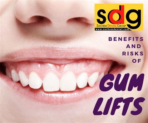 Benefits And Risks Of Gum Lifts Sachem Dental Group