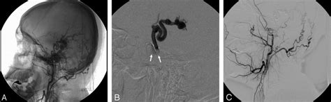 Patient 6 A Native Radiogram Of Right External Carotid Arteriogram In Download Scientific