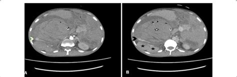 Contrast Enhanced Ct Cect To Identify Any Area Of Active Bleeding A