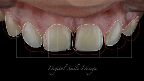 Digital Smile Design Dr Pankaj Mehta Dental Care Center