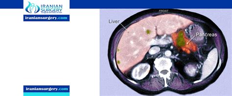 pancreatic cancer stages timeline | pancreatic cancer stage 4 timeline