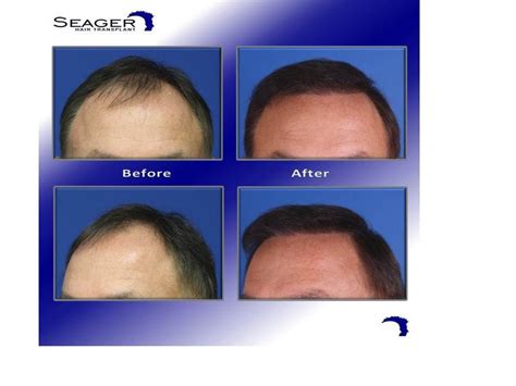 3000 Grafts Hair Transplant Cost Stombaughtrautman