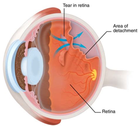 Retinal Detachments Retina Macula Consultants Of California