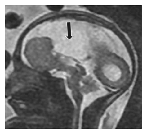 Complete Agenesis Of Corpus Callosum Gestational Age 27 Weeks A Download Scientific