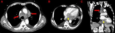 Thoracic CT-scan showing mediastinal lymphadenopathies (red arrows) and ...