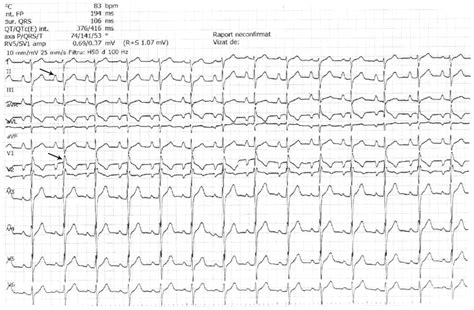 Twelve Lead Standard Electrocardiogram Normal Sinus Rhythm