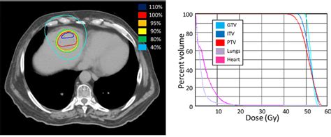 Stereotactic Body Radiotherapy Sbrt Treatment Plan For Patient 1 A