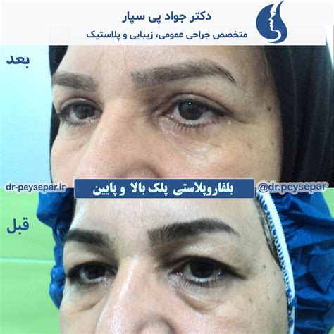 نمونه کار دکتر جواد پی سپار متخصص جراحی عمومی، زیبایی و پلاستیک در اهواز