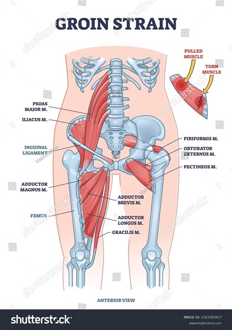 Groin Strain Trauma Pulled Torn Muscle Stock Vector (Royalty Free ...