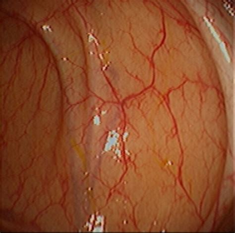 Normal Colon Mucosa