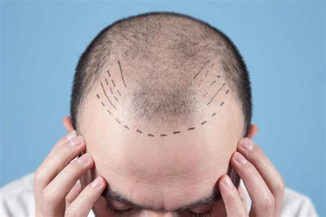 Different Methods Of Fue Hair Transplant In Cyprus