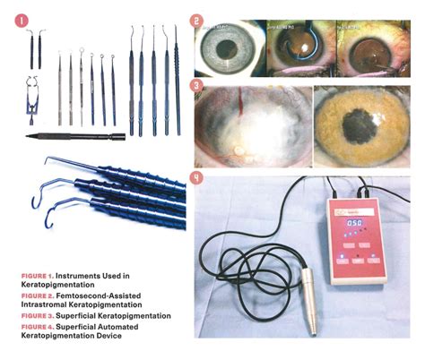 Cosmetic Surgery of the Cornea: A new type of Surgery - Blue Green Medical